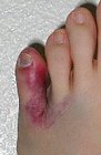 brokenpinkytoe-140